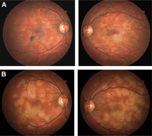 Figure 1 (A and B) Fundus of a 30-year-old man diagnosed with acute multifocal placoid pigment epitheliopathy. (A) Acute phase of disease; (B) scar phase of the disease.