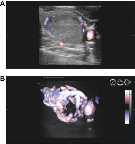 Figure 2 (A) Low intra- and peri-nodular vascularisation observed in 2D examination. (B) Increased intra- and peri-nodular vascularisation observed in 3D examination (same nodule).