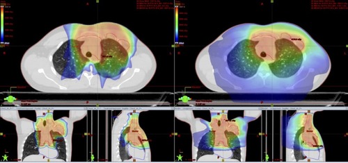 Figure 3 Comparative planning proton vs photon in free-breathing. Left: protons (DS); Right: RapidArc.