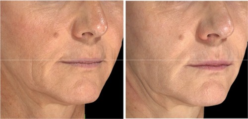 Figure 2 Patient at baseline (left) and 4 weeks after receiving one SP-HA injection in the face (right).
