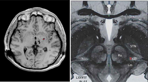 Figure 1. LEFT. T1 Weighted Axial Magnetic Resonance image showing multi-target DBS with bilateral thalamic (VIM and VoP) leads along with ipsilateral Gpi DBS (red dot). RIGHT. Upper midbrain anatomical axial image showing the relevant Posterior Subthalamic area DBS anatomy and neurosurgical target (Red X). Red Nucleus (Ru), Subthalamic nucleus (STN), Caudal zona Incerta (cZi), medial lemniscus (Lm). Full color available online