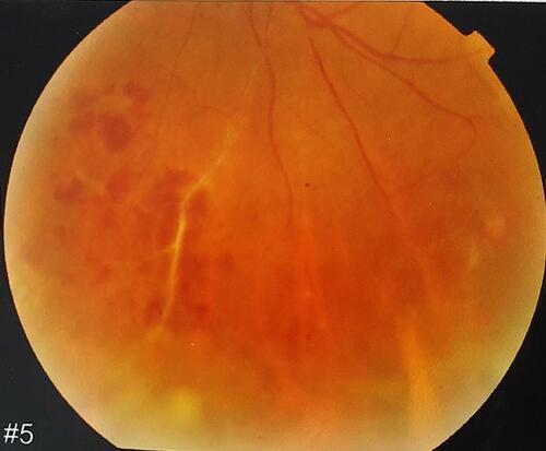 Figure 2 Intermediate uveitis and peripheral vasculitis in a patient with tuberculosis.