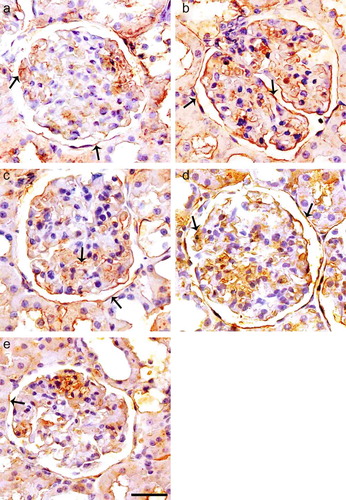 FIGURE 2. Immunoperoxidase staining of TGF-β1 in glomeruli of control (a), diabetic untreated (b), diabetic treated with Irb (c), diabetic treated with ALA (d), and diabetic treated with Irb + ALA (e) rats. Immunostaining of TGF-β1 is increased in glomeruli and tubuli of diabetic rats as compared with the control rats. Immunostaining of TGF-β1 is decreased in glomeruli and tubuli of diabetic-treated rats as compared with the diabetic untreated rats (arrows: positive immunostaining for TGF-β1, immunoperoxidase, hematoxylin counterstain; scale bar, 25 μm).