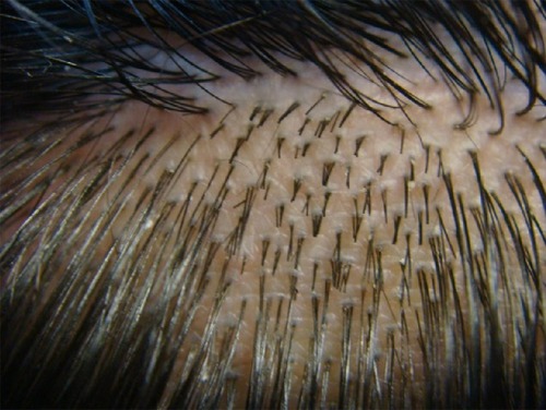 Figure 1 View of scalp hair demonstrating follicular units. These are naturally occurring clusters of hair in the scalp and usually occur as single hairs, two-hair or three-hair groupings.