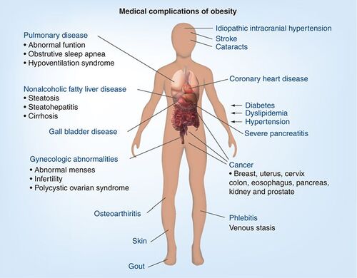 Figure 1. Obesity leads to enormous strain on a great deal of the body’s systems leading to cardiovascular disease, diabetes and decreased life expectancy.