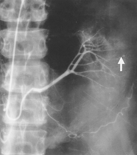 Figure 2. Renal angiogram showing multiple microaneurysms in the intrarenal arteries (arrow).