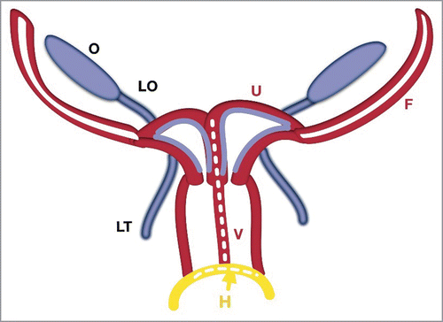 FIGURE 4. Schematic Stage of Two Utero-Vaginal Fusion. The 2 utero-vaginal ducts are initially separated by an intermediate septum. Fusion of the hemi-uterus and hemi-vagina forms a complete septate uterus with a duplicated vagina. The intermediate septum reduces and forms a normal uterus. The hymen (H-yellow) is a mucous membrane between the fused mesonephral ducts with the urogenital sinus.