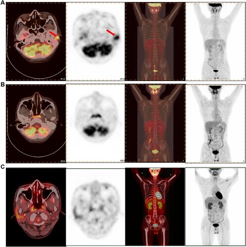 Figure 2. (A) PET-CT images of the head and whole body of the patient 1. Red arrows indicate the EMR in the left external auditory meatusa. (B) PET-CT after decitabine plus ATRA and ATO combination chemotherapy with local radiotherapy, which resulted in disappearance of the EMR in the left external auditory meatusa. (C) PET-CT after 1 month of Gilteritinib therapy showing complete disappearance of the EMR in the left lumber.