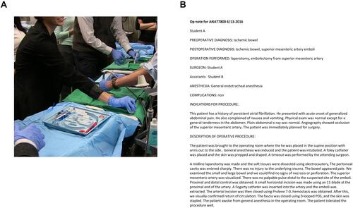 Figure 3 Team based interactive learning experience. (A) Students participated in each simulated operation as a team-based approach and technical skills training included use of central lines and ultrasound. (B) Students were required to write operative notes after each procedure and this is an example of one of those notes.