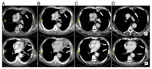 Figure 1. CT scan of a malignant pleural mesothelioma patient receiving tremelimumab. (A–D) Computer tomography (CT) scans were performed at baseline (A) and after the second (day 180, B), fourth (day 470, C), and seventh (day 630, D) dose of tremelimumab. The patient achieved a partial response (C and D) after initial disease progression was noted at the first (data not shown) and second assessments (B).