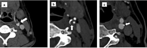 Figure 2 (a) Plaque ulcers; (b) Napkin ring sign; (c) Point calcification.