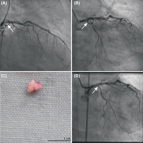 Figure 2. Coronary angiogram demonstrated a hazy filling defect (arrow) at the bifurcation of the distal left main trunk and left circumflex artery, depicted in right anterior oblique caudal (A) and left anterior oblique caudal projections (B). A fibrous mass was aspirated by a thrombectomy catheter (C), with resolution of the filling defect on coronary angiogram (arrow, D). LAD, left anterior descending artery; LCx, left circumflex artery.