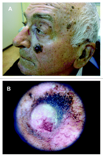 Figure 8. (A) Histologically confirmed lentigo maligna melanoma on left cheek of an elderly male patient, arising from a lentigo maligna after many years. (B) Dermoscopic picture of LMM on same patient.