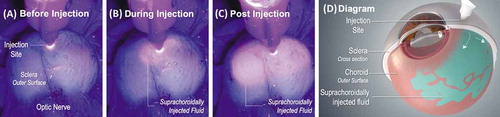 Figure 2. Suprachoroidally injected fluorescing dye under UV light in an ex vivo porcine eye before (A), during (B), and immediately post (C) injection shows posterior and circumferential spread of the injectate within the suprachoroidal space (SCS), as seen by the fluorescing particles emitting light through the scleral tissue. (D) is a diagram of a partial cross-section of an eye with suprachoroidally injected fluid spreading posteriorly and circumferentially between the sclera and choroid around the globe