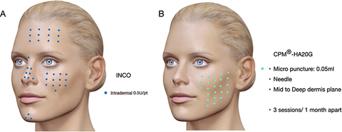 Figure 5 Step 5 Décor (improvement of skin surface). (A) Step 5A; Injection points and units of INCO: to improve skin quality. (B) Step 5B; Injection points, plane, technique of HA20G to improve skin viscoelastic properties. (Image partially reproduced from Merz Institute Advanced Aesthetics platform-www.merz-institute.com).