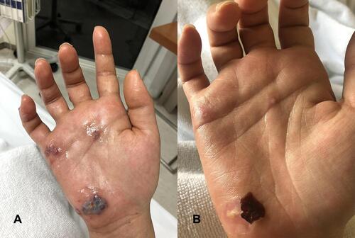 Figure 1 Clusters of round and polygonal vesicular lesions on erythematous to violaceous base at the right hand (A) and post-intravenous acyclovir treatment (B) along with the ulnar nerve distribution with a claw-like deformity of the right hand.