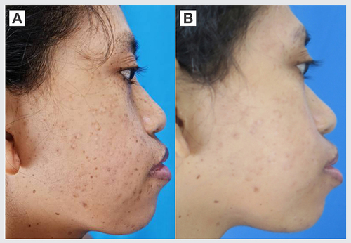 Figure 3 Comparison between skin manifestation before and after two sessions of treatment. (A) Hyperpigmented macules on right cheek. (B) Improvement on right cheek skin lesions after two sessions of treatment.