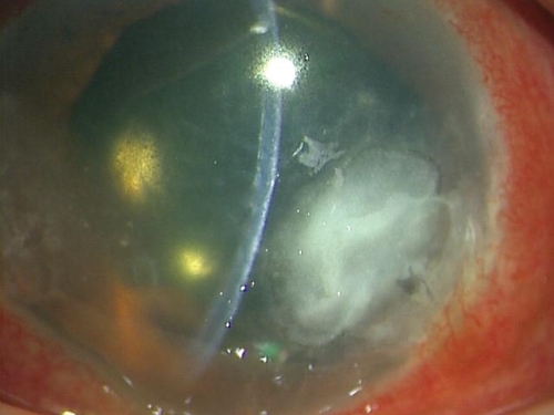 Figure 1 At the patient’s first visit to our hospital, a slit lamp examination showed a temporal corneal ulcer at the 5 o’clock position. The lesion was restricted to the superficial stromal layer, with no endothelial plaque and very little anterior chamber inflammation.