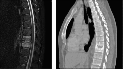 Figure 1. MRI image (left) and a CT scan (right) from a patient treated nonoperatively.