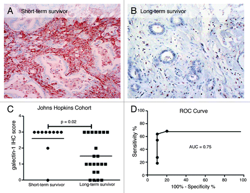 Figure 2. Galectin-1 staining in VLTS and STS in validation cohort 1 (Johns Hopkins cohort). Galectin-1 IHC of invasive pancreatic cancer displaying strong staining (3+, brown color) in desmoplatic stromal cells from a patient with short-term survival (A) and absent immunostaining in a VLTS patient (B). Distribution of galectin-1 staining from short-term survivors and very long-term survivors (C). ROC curve analysis displaying an ROC of 0.75, and 64% sensitivity and 90% specificity in predicting very long-term survival (D).
