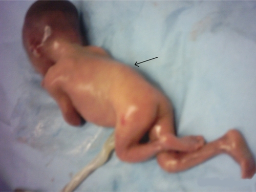 Figure 3 The stillborn female neonate presents obvious deformation of the spine (arrow).