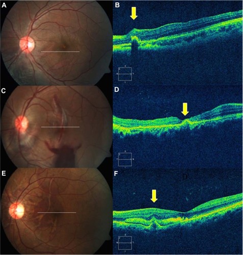 Figure 1 Type 1 indirect choroidal rupture (ICR). (A) Extrafoveal ICR nasal to the fovea. (B) Domed-shape elevation with loss of continuity at the base of dome. (C) Multiple ICRs at the macula involving fovea. (D) Subfoveal rupture with apparently intact retinal pigment epithelium-choriocapillaris layer. (E) Multiple ruptures, just sparing the fovea, with subretinal hemorrhage. (F) Extrafoveal pyramid-shape elevation with break in the tip and subfoveal hemorrhage.