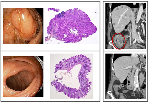 Figure 2. Left framed panel: The primary tumor site; baseline endoscopy and biopsy (top), endoscopy and biopsy at radiologic complete response (bottom). Right framed panel: The metastatic disease; the primary tumor (encircled) and multiple liver metastases at baseline (top), the ascending colon and liver at radiologic complete response (bottom). Further details are displayed in Supplementary Figures S3 and S5.