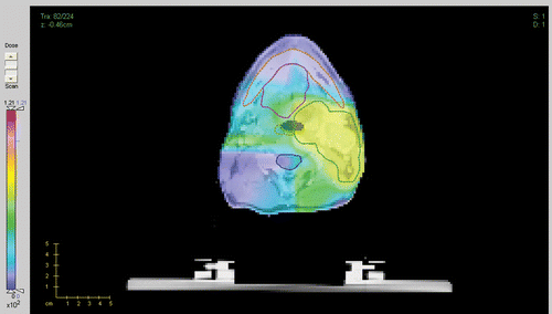 Figure 4. Dose map for the IPR plan. Colours correspond to different doses (left slider). The PTV is outlined with the green dotted line. The cord, mandible, pharynx and oral cavity are outlined with the blue, orange, light green and purple lines. (Available in colour online.)