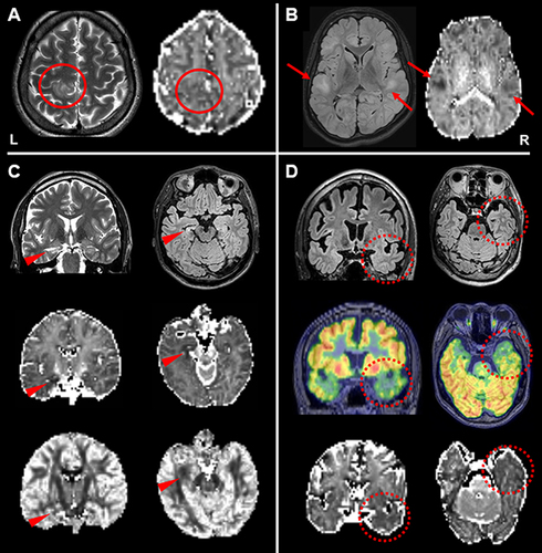 Figure 2 (A) In a 46-year-old patient with focal epilepsy, reduced neurite density is evident in the focal cortical dysplasia (circles). (B) A 17-year-old patient with tuberous sclerosis. Reduced neurite density can be seen in the multiple cortical tubers (arrows). (C) A 37-year-old patient with left temporal lobe epilepsy and hippocampal sclerosis. The abnormal hippocampus shows reduced neurite density and orientation dispersion (arrowheads). (D) A 47-year-old patient with right temporal lobe without any visible lesions on conventional MRI. The right temporal lobe shows reduced neurite density in accordance with the hypometabolic areas of 18F-FDG-PET (broken circles).