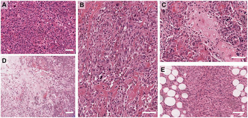 Figure 1 Examples of Metaplastic breast cancer morphologies. (A) High-grade, pleomorphic de-differentiated carcinoma (IBC-NST). (B) High-grade carcinoma with focal squamous differentiation. (C) Osteoid differentiation. (D) Chondroid differentiation. (E) Spindle differentiation. Scale bar is 100 µm.