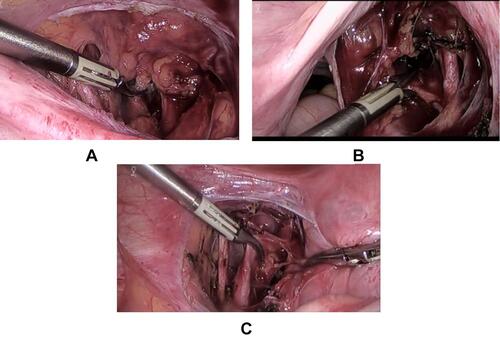 Figure 1 Three different approaches of laparoscopic uterine artery occlusion(LUAO). (A) The anterior leaf of the broad ligament. (B) The posterior leaf of the broad ligament. (C) The triangle area in the broad ligament.