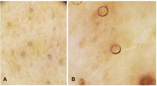 Figure 2 Dermoscopic examination: (A) multiple dark hairs with a perfectly circular arrangement, located under a thin layer of skin (original magnification x20); (B) close-up view of circle hairs (original magnification x80).