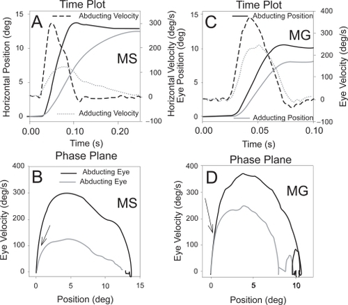 Figure 2 Comparison of true internuclear ophthalmoplegia due to multiple sclerosis (MS) (A and B) with pseudo-internuclear ophthalmoplegia due to ocular myasthenia gravis (MG) (C and D). Note that both patients show slower adducting movements (evident on the velocity channels of the time plots). However, on the corresponding binocular phase planes, the initial movements of abducting and adducting eyes are conjugate for the myasthenic (D – arrow) but differ from the onset of the movement for the patient with true INO (C – arrow). Positive values indicate rightward movements. Eye movements were recorded using the magnetic search coil technique (CitationLeigh and Zee 2006).