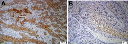 Figure 2 (A) CD109 expression in well-differentiated tumor and (B) in moderately differentiated tumor (both at ×20 magnification).