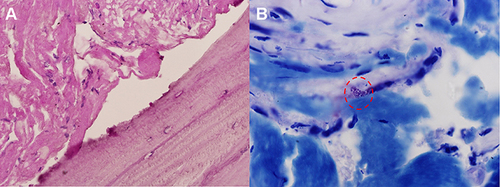 Figure 4 (A) HE staining showed partial dead bone and inflammatory cellulose exudate in osteonecrosis of the femoral head. (B) Giemsa staining revealed scattered positive Brucella (red circle).