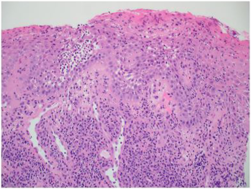 Figure 3 Hematoxylin and Eosin Stain, magnification X100 showing chronic inflammatory cell infiltrate present at the juxta epithelial and deeper connective tissue.