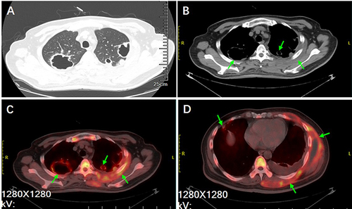 Figure 1 PET/CT imaging on pulmonary cavity lesions and thoracic wall abscess. (A and B) CT imaging on multiple lung cavity lesions in the upper lobes. (C and D) PET scan revealed that the lung lesions, chest wall and thoracic vertebrae had higher levels of glucose metabolism (Green arrows).