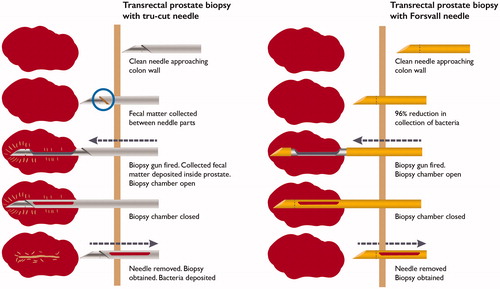 Figure 4. Schematic depiction of TRbx and bacteria/fecal matter deposition when using a standard tru cut needle (left) and the Forsvall needle prototype (right).