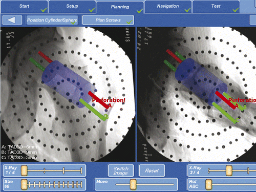 Figure 6. On leaving the safe zone the surgeon is warned by the appearance of the “Perforation” caption.