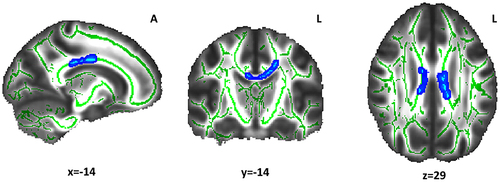 Figure 3 Radial diffusivity differences between the Long and Reference sleep groups. The light-blue color indicates the white matter clusters that showed higher radial diffusivity values (α ≤ 0.05, threshold-free cluster enhancement and family-wise error correction) in the Long sleep group compared with the Reference sleep group (at the indicated coordinates). The mean skeleton of FA is shown in green. The white matter tract includes the body of corpus callosum. Coordinates are presented in Montreal Neurological Institute (MNI) template space.