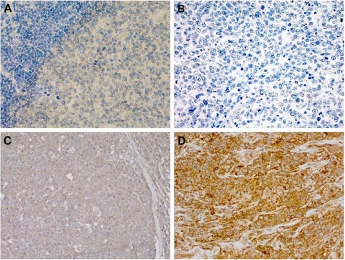 Figure 1 Expression of PIK3CA was evaluated using IHC in both DLBCL and RH tissues.