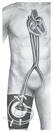 Figure 2 TandemHeart percutaneous LVAD, permission for use granted by CardiacAssist, Inc.