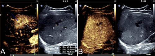 Figure 2 Contrast-enhanced ultrasound (CEUS)before surgery. CEUS showed the lesion (white arrow) was heterogeneous low hyperenhancement and a wedge-shaped high hyperenhancement (blue arrow) around the lesion in the arterial phase (A). The lesion (white arrow) was rapidly washout from the center in the Portal phase (B).