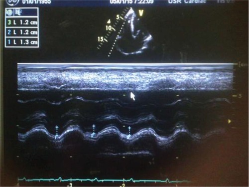 Figure 1 Abnormal TAPSE, 1.2cm (average value of 1,2 and 3 in Figure 1) in subjects with HF.