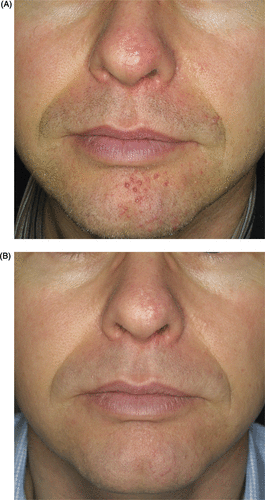 Figure 3. (A) Angiofibromas in the facial region of a 41-year-old man with tuberous sclerosis. (B) Results after five treatment sessions with the argon laser, 1.3 W of power, 2 mm spot size, 300 ms pulse duration.