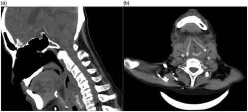 Figure 3 (a,b). CT Neck contrast two weeks post treatment revealed no residual tumour and no evidence of bone or cartilage erosion seen.