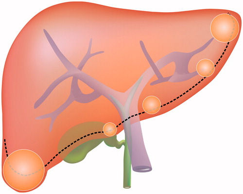Figure 1. Schematic diagram of tumour locations at the inferior margin of the liver including portions of segments 2, 3, 4 on the left, segments S5 and S6 on the right, where the thickness of liver is less than 5 cm. For tumours in this location, the distance between the tumour and hepatic surface is less than 5 mm.