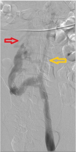 Figure 4 Lower extremity venogram. Interrupted IVC (yellow arrow) and lower extremity drained by hemiazygos veins (red arrow).
