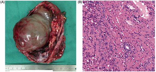 Figure 3. Resected HMH tumor and pathology.