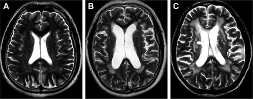 Figure 1 Different scores of P-WMH.Notes: (A) One point = “caps” or pencil-thin lining; (B) two points = smooth “halo”; (C) three points = irregular P-WMH extending into the deep white matter.Abbreviation: P-WMH, paraventricular white matter hyperintensities.